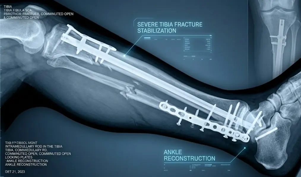 High-tech visualization of complex metal hardware stabilizing multiple shattered bone fragments in the right leg.